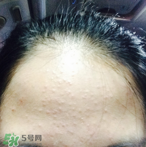 長痘長閉口怎么辦？長痘長閉口是什么原因？