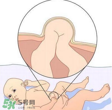 臍疝是什么？臍疝對寶寶有什么影響？
