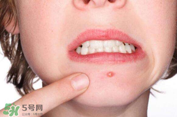 暗瘡可以擠壓嗎？油性和骯臟肌膚會容易有暗瘡嗎？