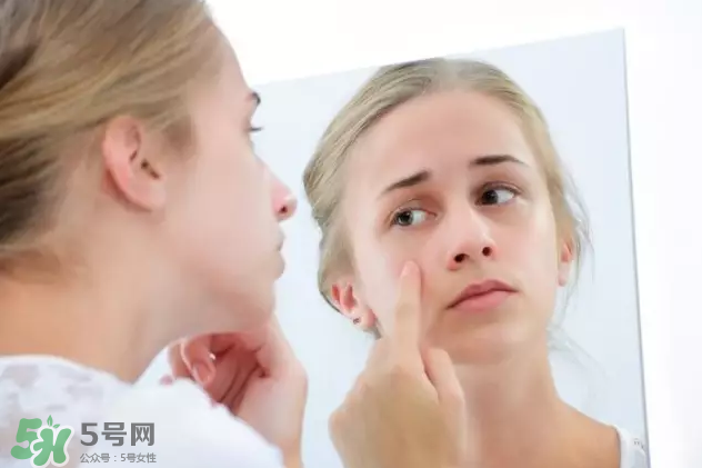 暗瘡可以擠壓嗎？油性和骯臟肌膚會容易有暗瘡嗎？