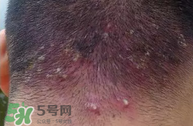痤瘡和毛囊炎一樣嗎？痤瘡與毛囊炎區(qū)別