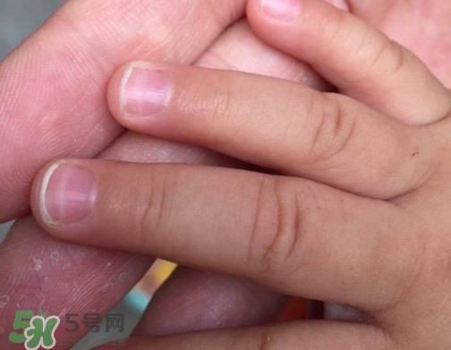 寶寶手指甲有白痕怎么回事？幼兒手指甲發(fā)白是缺鈣嗎