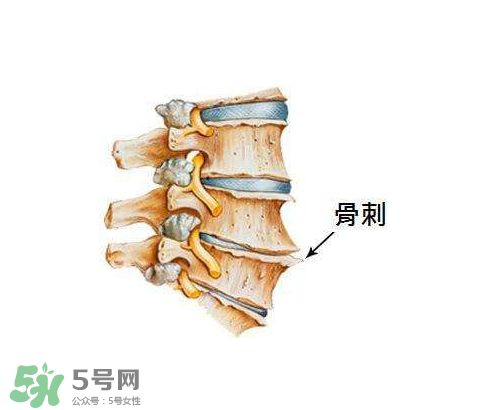 骨刺是怎么形成的？骨刺怎么治療？