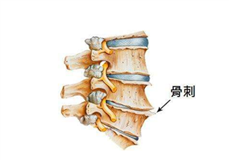 骨刺是怎么形成的？骨刺怎么治療？