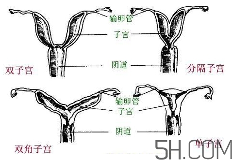 子宮畸形有哪些？子宮畸形有什么影響？