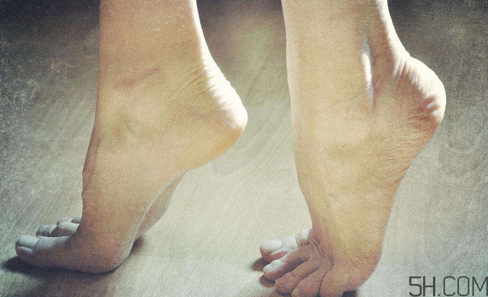 腳氣是什么原因引起的？腳氣是濕氣重引起的嗎?