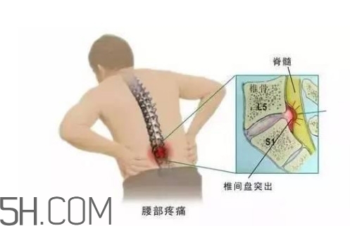 腰間盤突出是什么原因引起的？腰間盤突出是腎虛嗎