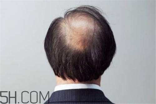 為什么男性比女性更容易脫發(fā)？什么原因?qū)е履行悦摪l(fā)？