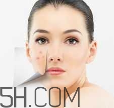 濕熱型痤瘡是什么？怎么調(diào)理濕熱型痤瘡？