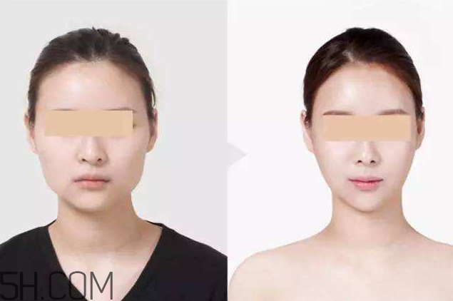 打瘦臉針可以抽煙嗎？打瘦臉針會(huì)反彈嗎？