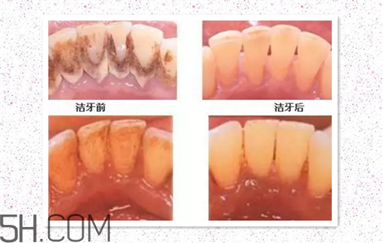 超聲波洗牙可以美白牙齒嗎？超聲波洗牙多少錢一次？