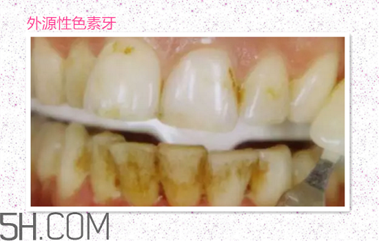 超聲波洗牙可以美白牙齒嗎？超聲波洗牙多少錢一次？