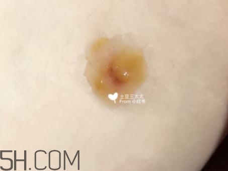 美寶濕潤(rùn)燒傷膏怎么樣？美寶濕潤(rùn)燒傷膏有用嗎？