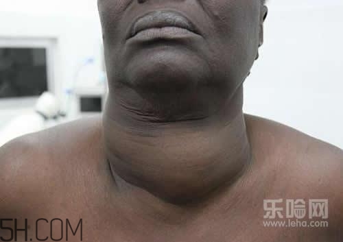 甲狀腺腫大和甲亢的區(qū)別有哪些？甲狀腺腫大適合吃什么食物？