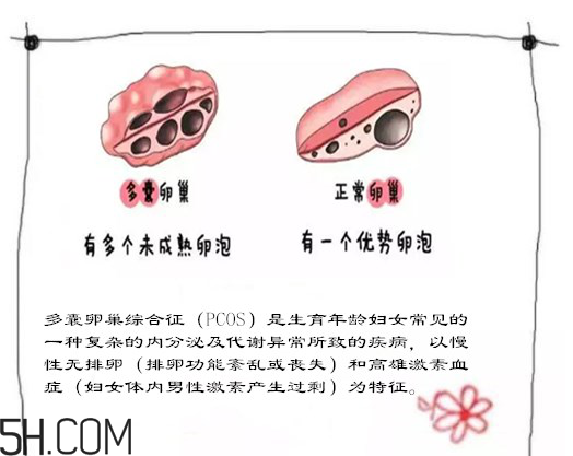 多囊卵巢生不了？多囊卵巢懷孕要看準(zhǔn)時(shí)間