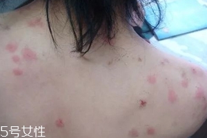 螨蟲有哪些危害？嚴(yán)重時(shí)肌膚糜爛