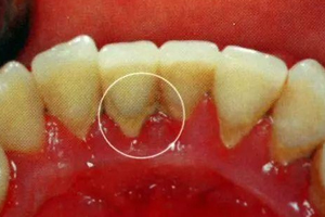 牙結(jié)石能自動(dòng)脫落嗎？除了洗牙別無他法
