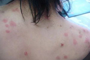 螨蟲(chóng)有哪些危害？嚴(yán)重時(shí)肌膚糜爛