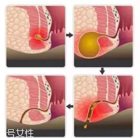 肛瘺非手術(shù)治療才可以嗎？手術(shù)是治療的關(guān)鍵途徑
