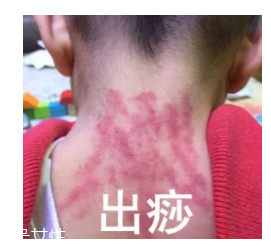 吮痧有什么療效？最溫柔的治病方法