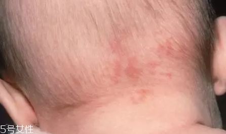 痣什么情況下會轉(zhuǎn)變?yōu)榱?？點痣不可取