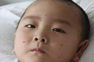 痣什么情況下會轉(zhuǎn)變?yōu)榱觯奎c痣不可取