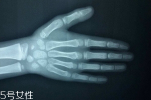 哪些人需要測骨齡？長太快警惕骨齡提前