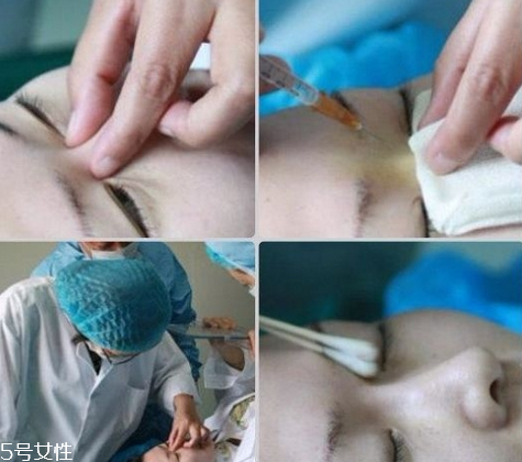 玻尿酸隆鼻維持時(shí)間受什么影響？玻尿酸不能過度注射