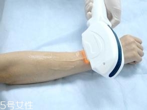 激光脫毛需要幾次？激光脫毛并不是終身有效的