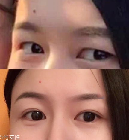 內(nèi)雙怎么進化成雙眼皮？全是雙眼皮貼的功勞