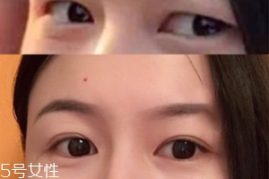 內(nèi)雙怎么進化成雙眼皮？全是雙眼皮貼的功勞
