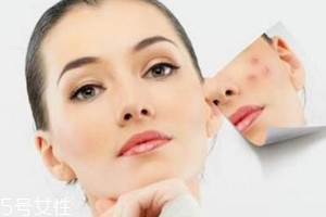 痘印多久能自行消失？多數(shù)人一年內(nèi)消失