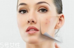 痘印多久能自行消失？多數(shù)人一年內(nèi)消失