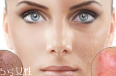痘印多久能自行消失？多數(shù)人一年內(nèi)消失