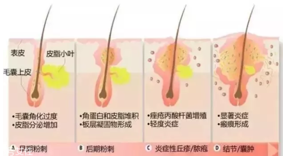 封閉性粉刺的發(fā)病機制是什么？角質(zhì)層太厚