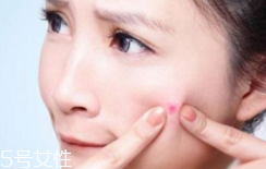 肌膚需要排毒嗎？長(zhǎng)痘并不代表排毒