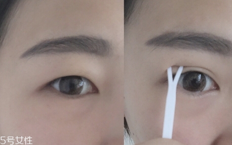雙眼皮貼一般多少錢？