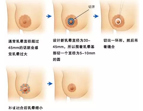 乳暈縮小術(shù)怎么做？乳暈縮小術(shù)知識(shí)全解