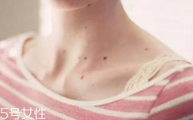 色素痣是腫瘤嗎？良性腫瘤不必擔(dān)心