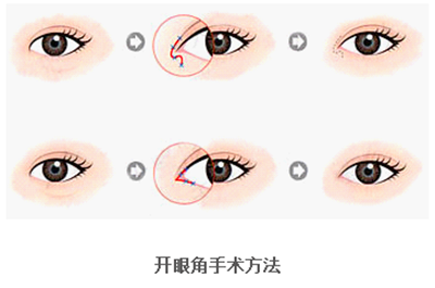 開眼角疤痕多久消失？開眼角的適宜人群