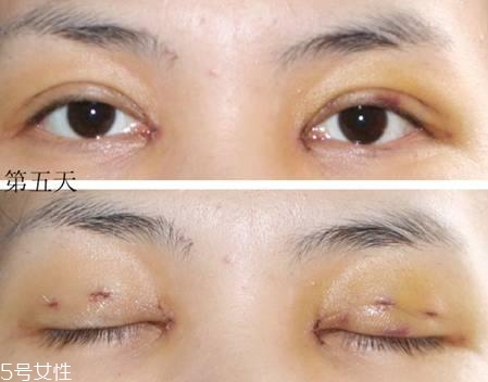 怎么縮短開眼角疤痕消失時間？雙眼皮開眼角恢復(fù)過程