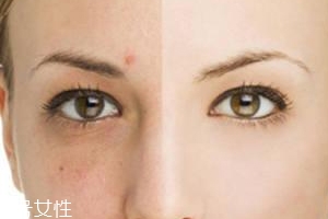 祛痘產(chǎn)品怎么選？先要分清痘印類型