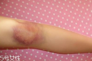 身體淤青怎么來(lái)的？不是磕碰那么簡(jiǎn)單