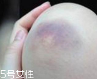 身體淤青怎么來(lái)的？不是磕碰那么簡(jiǎn)單