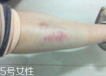 身體淤青怎么來(lái)的？不是磕碰那么簡(jiǎn)單