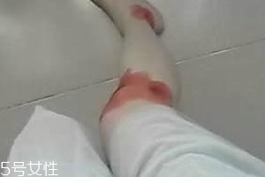 摔傷了涂什么藥好的快？做好消毒才能愈合快