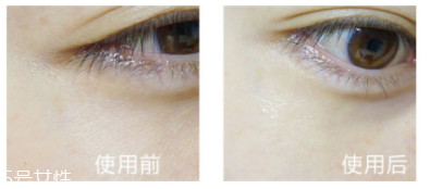shangpree香蒲麗眼膜適合多大年齡？任何年齡