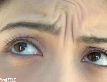 川字紋可以手術(shù)去除嗎？選擇手術(shù)需謹(jǐn)慎