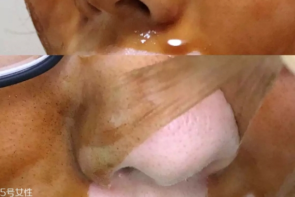 雪花秀撕拉面膜怎么撕出黑頭？這么做才能去黑頭