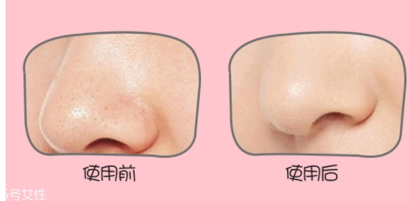 yoii黑頭儀怎么用？yoii黑頭儀怎么充電